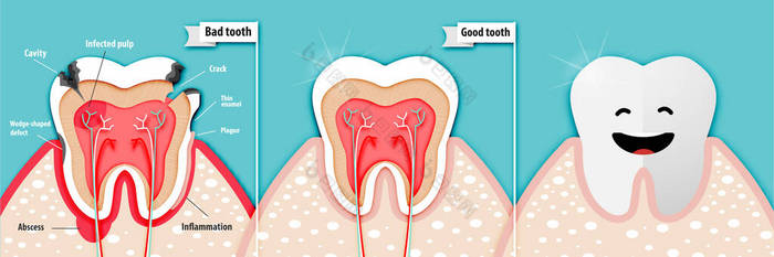 关于坏牙齿和好牙齿载体的健康科学纸艺