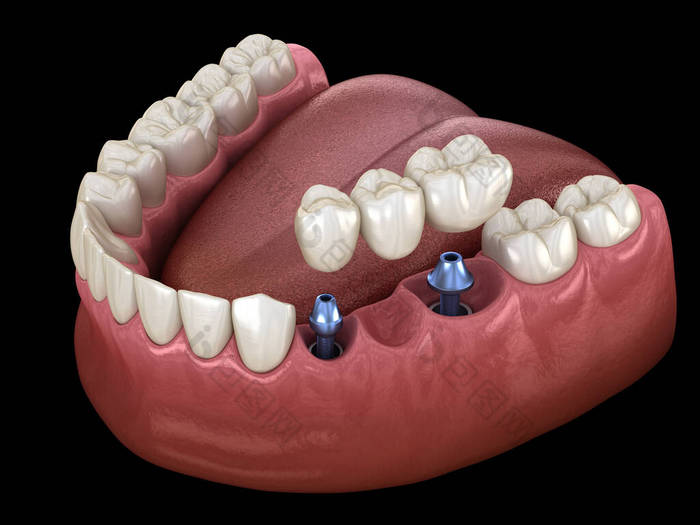 由植入物支撑的牙桥.医学上准确的人类牙齿和假牙概念三维图像