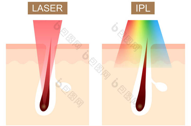 <strong>激光</strong>和IPL (强脉冲光)<strong>脱毛</strong>差异.护肤概念
