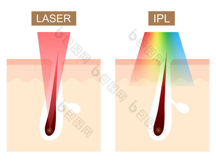 激光和IPL (强脉冲光)脱毛差异.护肤概念