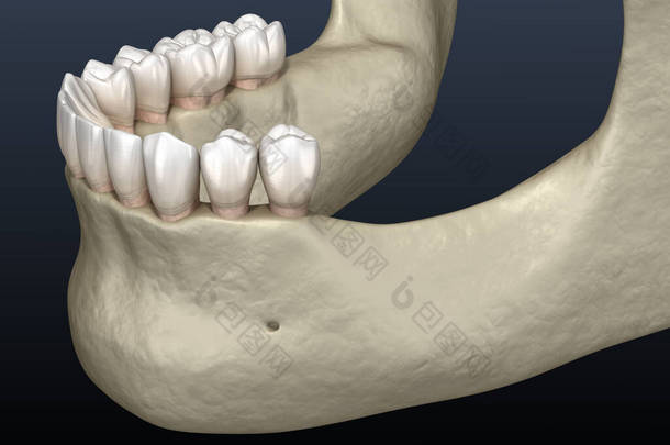 下颌骨下颌骨,下颌牙脱落后骨萎缩.医学上准确的牙科3D图像