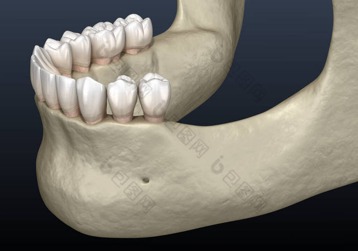 下颌骨下颌骨,下颌牙脱落后骨萎缩.医学上准确的牙科3D图像