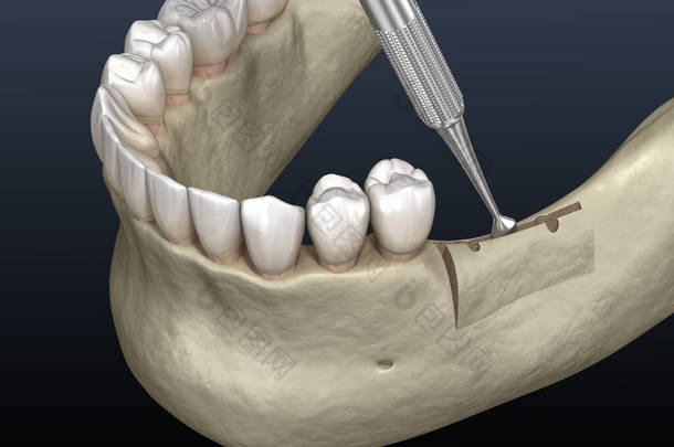 肺泡脊的裂缝，隆起。牙科<strong>手术</strong>，3D图解