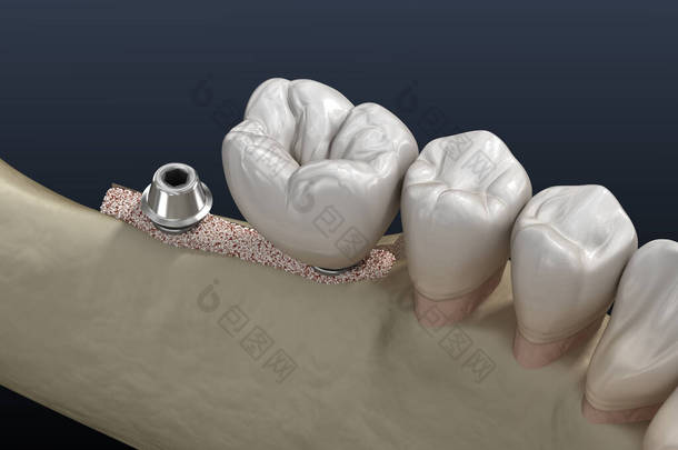 肺泡脊的裂隙：植入。牙科<strong>手术</strong>，3D图解