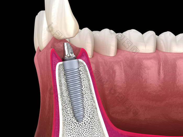 标准基托,假牙植入物和陶瓷冠.医学上准确的牙齿3D图像.