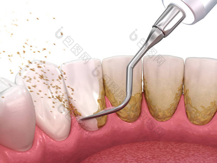 口腔卫生：烫伤和根部修整（常规牙周病治疗） 。医学上准确的人类牙齿治疗三维图像
