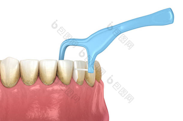 口腔卫生：使用牙签牙线去除牙齿上的食物。医学上准确的牙科3D图像