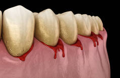 牙龈出血或牙周炎-牙龈和骨支撑的病理状态.牙科3D图解