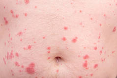 如荨麻疹或过敏等皮肤病的特写。有皮疹的人体