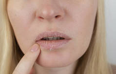 女人在嘴唇上检查干枯的皮肤.剥皮，粗糙，不适，皮肤敏感。皮肤科医生或美容师指定的病人。干皮片的特写