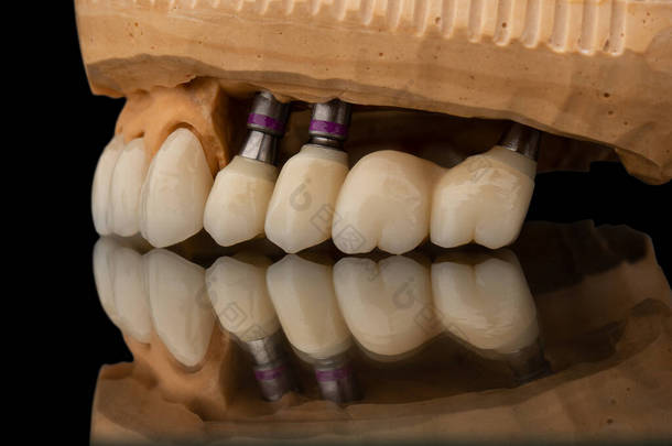 在黑色玻璃背景的牙齿上颌骨假体的特写侧视图。人造下颚，有镶边和冠冕。植入物的牙齿恢复。牙科学概念照片。假牙科