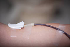 献血活动中用针和纱布进行献血者的胳膊.