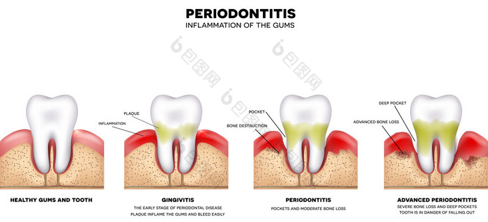 牙周炎的牙龈发炎，
