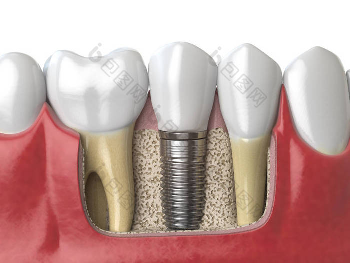 人 dentu 牙牙种植体的解剖学研究