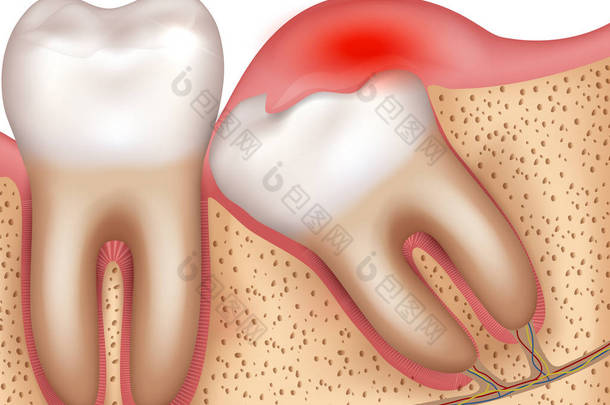 智齿爆发问题发炎牙龈说明解剖