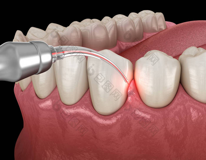 用激光进行牙龈矫正手术.医学上准确的牙齿3D图像