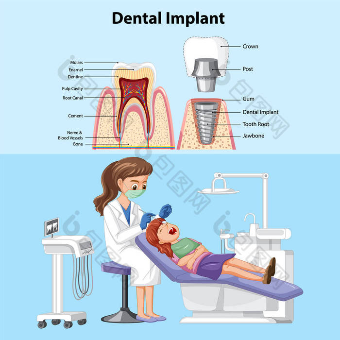 牙周植入物及牙科医生检验病人牙齿图解