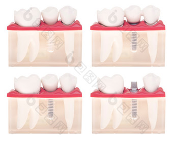 牙科模型与不同的类型治疗植入物放置保税桥皇冠在植入物孤立的白色背景