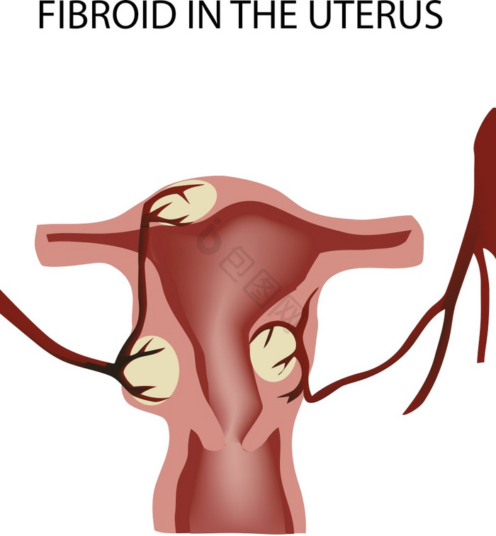 女器官肿瘤疾病子宫肌瘤女器官肿瘤疾病器官图片