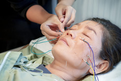 亚洲女人经历针灸美脸治疗电针设备