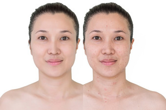 美丽的年轻的女人与和没有老化演唱皱纹瑕疵摩尔之前和后激光治疗塑料过程抗衰老治疗之前和后激光治疗