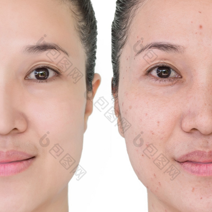 美丽的年轻的女人与和没有老化演唱皱纹瑕疵摩尔之前和后激光治疗塑料过程抗衰老治疗之前和后激光治疗