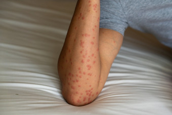 关闭发红瘙痒和肿胀后许多蚊子咬的手臂过敏蚊子唾液可以导致丘疹的荨麻疹蚊子rsquo并发症状