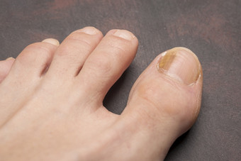 脚趾甲与真菌问题甲真菌病也已知的癣锑真菌<strong>感染</strong>的指甲黑暗背景