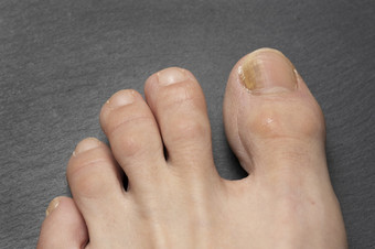 脚趾甲与真菌问题甲真菌病也已知的癣锑真菌感染的指甲灰色的表格