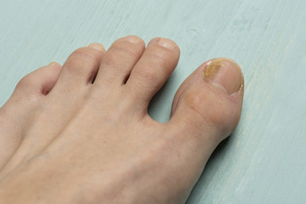 脚趾甲与真菌问题甲真菌病也已知的癣锑真菌感染的指甲绿色表格