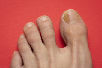脚趾甲与真菌问题甲真菌病也已知的癣锑真菌感染的指甲红色的表格