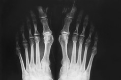 x射线的脚外翻畸形的然后骨手指学位整形疾病