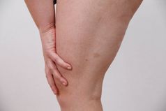 女人显示持有和推的皮肤的腿脂肪团橙色皮治疗和处理多余的重量的沉积皮下脂肪组织