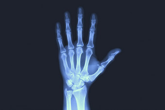 x射线检查人类手x射线手骨头x射线检查人类手x射线手骨头