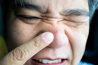 亚洲的家伙采取<strong>指数</strong>手指大丘疹和黑头粉刺青春痘和痤疮伤疤他鼻子