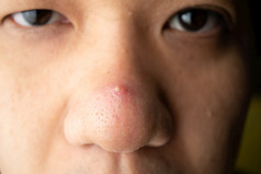 收盘上涨许多黑头粉刺青春痘和痤疮伤疤的鼻子亚洲皮肤脸