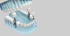 组件牙科植入物蓝色的颜色透明的插图