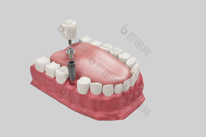 牙科植入物治疗过程医学上准确的插图假牙概念