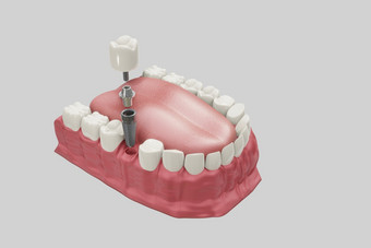 <strong>牙科</strong>植入物<strong>治疗</strong>过程医学上准确的插图假牙概念