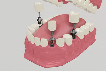 <strong>牙科</strong>植入物<strong>治疗</strong>过程医学上准确的插图假牙概念