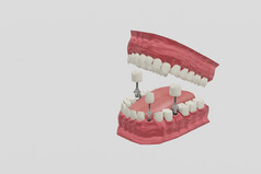 牙科植入物治疗过程医学上准确的插图假牙概念
