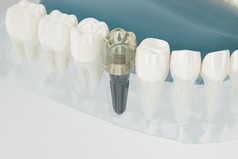 关闭组件牙科植入物透明的呈现