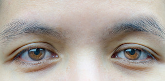 宏拍摄亚洲中间岁的女人棕色（的）眼睛与皱纹下的眼睛和显示静脉眼睛眼睑问题需要手术为电梯