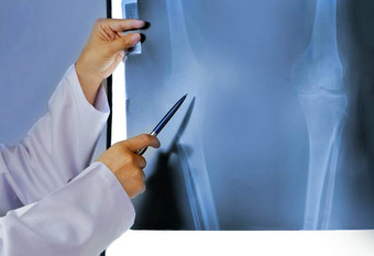女医生手使用笔指出膝盖加入x射线电影发光的<strong>屏</strong>幕放射学<strong>整</strong>形单位医院占领和医疗医疗保健概念