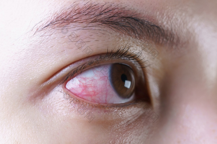 红色的充血眼睛女人恼怒的受感染的结膜炎眼睛后哭