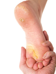 皮肤科医生检查脚为愈伤组织而且干皮肤对白色