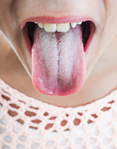 年轻的女人突出的白色斑块舌头