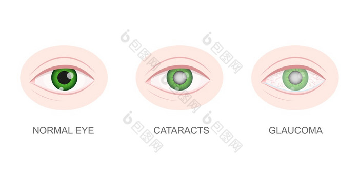 健康的白内障和青光眼眼睛特写镜头视图眼球与正常的和不健康的镜头老化视觉问题概念在解剖学上详细的人类器官愿景向量卡通插图健康的白内障和青光眼眼睛特写镜头视图眼球与正常的和不健康的镜头老化视觉问题概念在解