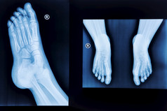 x射线人类脚正常的射线照相法的脚医疗诊断创伤学和整形外科