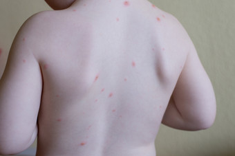 水痘疾病水痘模式的皮肤两个一年老男孩
